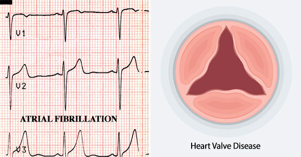 Atrial Fibrillation &amp; Aortic Stenosis Diagram