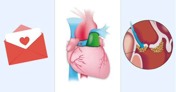 Ross Procedure &amp; Endocarditis