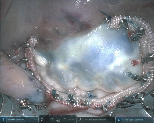 Mitral Valve Repair Ring
