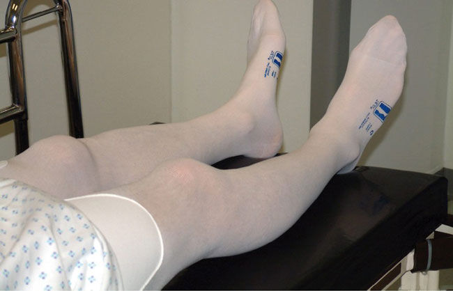 Compression Stockings