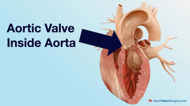 Drawing of the Aortic Valve inside the Aorta