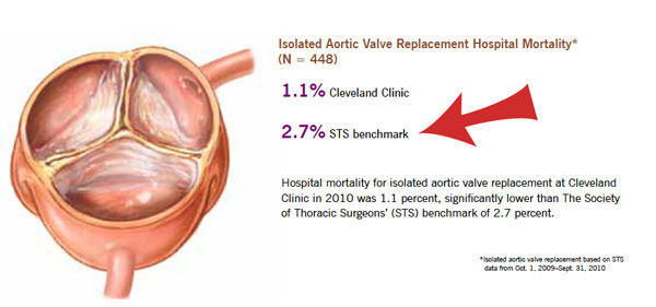 Aortic Valve Replacement Mortality Rate &amp; Risks