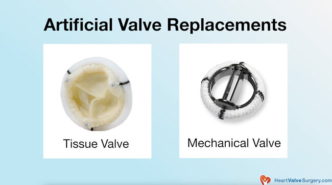 Artificial Tissue &amp; Mechanical Heart Valve Replacement
