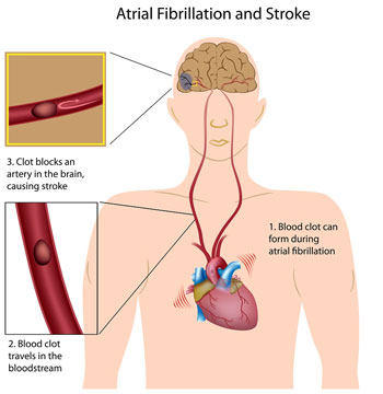 Diagram Showing The Connection Between Atrial Fibrillation &amp; Stroke