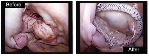 Before &amp; After Pictures Of Mitral Valve Repair Surgery