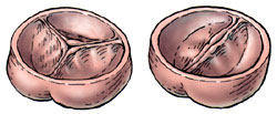 Bicuspid &amp; Tricuspid Aortic Valve Drawings