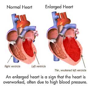 Normal &amp; Enlarged Heart Comparison
