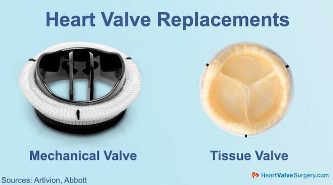 Heart Valve Replacement Options Mechanical &amp; Tissue