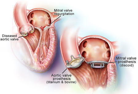 Heart Valve Replacement Diagram For Aortic &amp; Mitral Positions