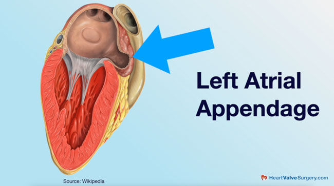 Left Atrial Appendage