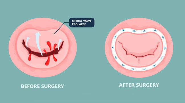 Mitral Valve Repair - Before &amp; After