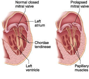 Normal &amp; Prolapsed Mitral Valve Showing Mitral Chordae