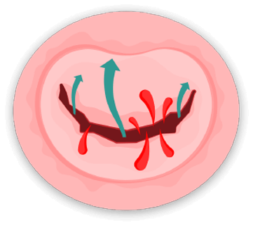 The Problem - Mitral Valve Disease