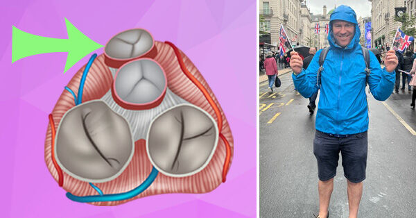 Pulmonary Valve for Ross Procedure