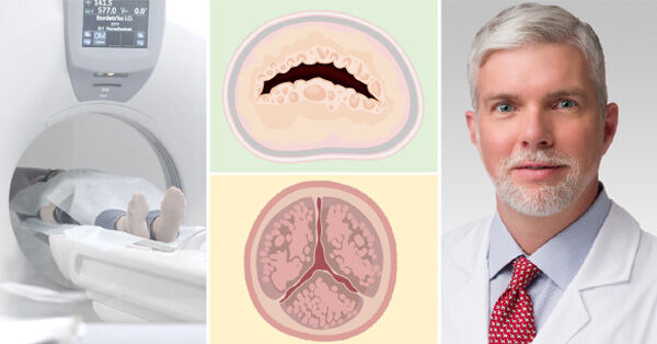 Radiation Therapy &amp; Heart Valve Disease with Dr. Douglas Johnston