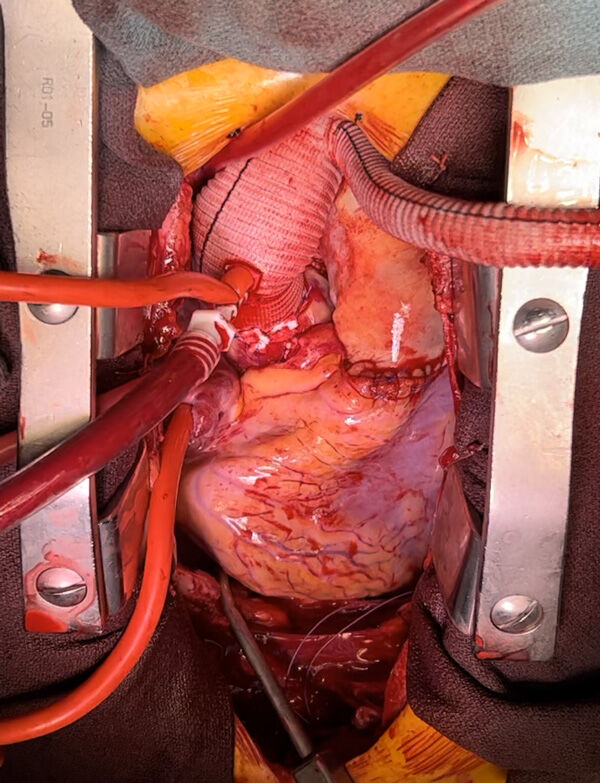 Ross Procedure &amp; Aortic Aneurysm Repair by Dr. Christopher Burke