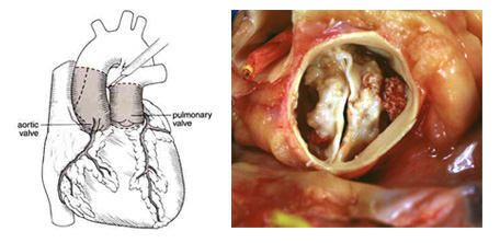 The Ross Procedure &amp; Bicuspid Valve