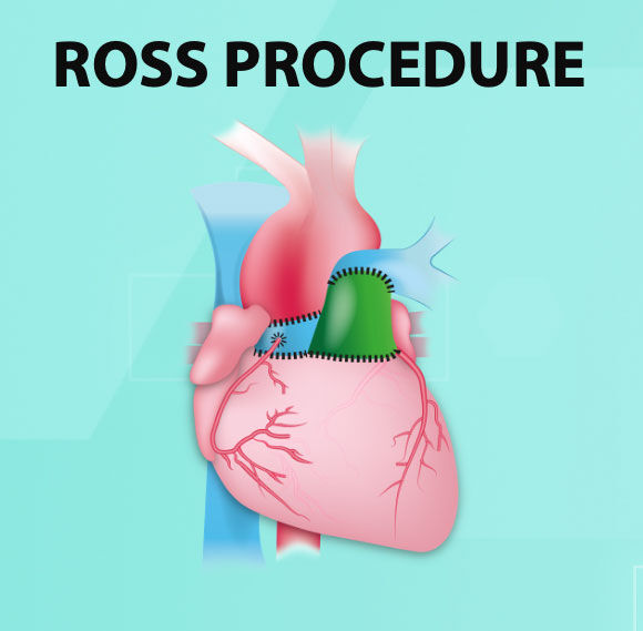 Ross Procedure