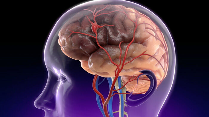 Stroke Risk &amp; Heart Valve Calcifcation