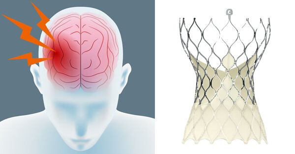 Stroke Risk, TAVR &amp; Cerebral Protection