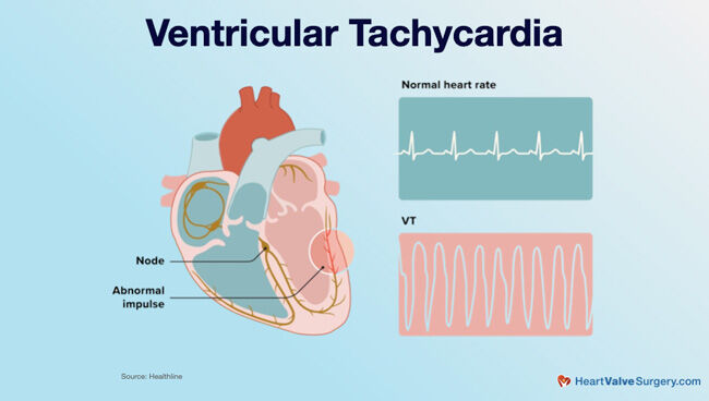 Ventricular Tachycardia &amp; Mitral Regurgitation