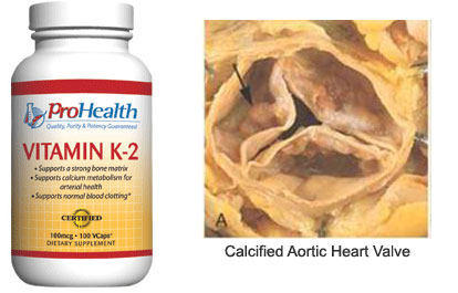 Vitamin K2 &amp; Calcifed Heart Valve Stenosis