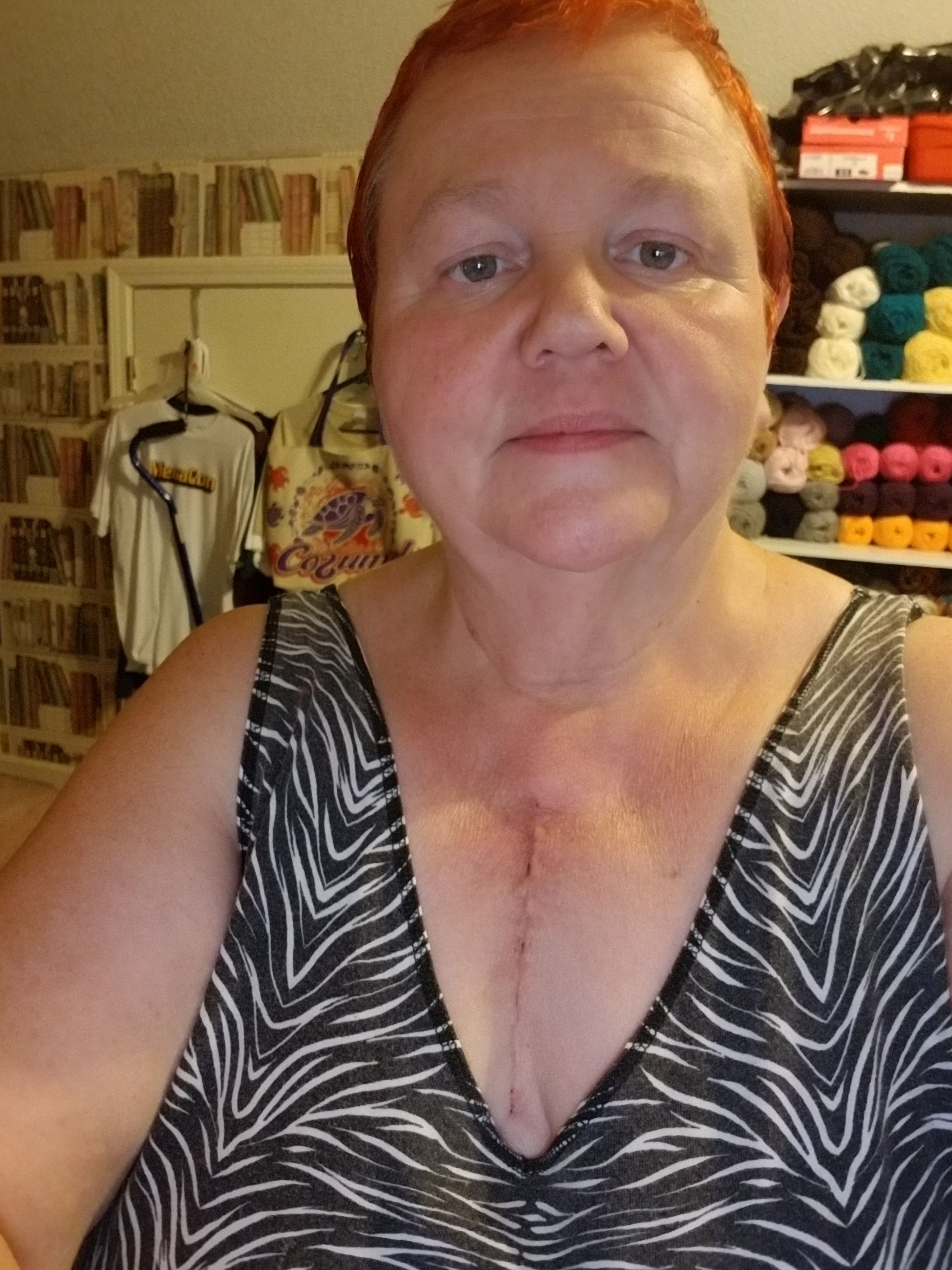 3 weeks post op