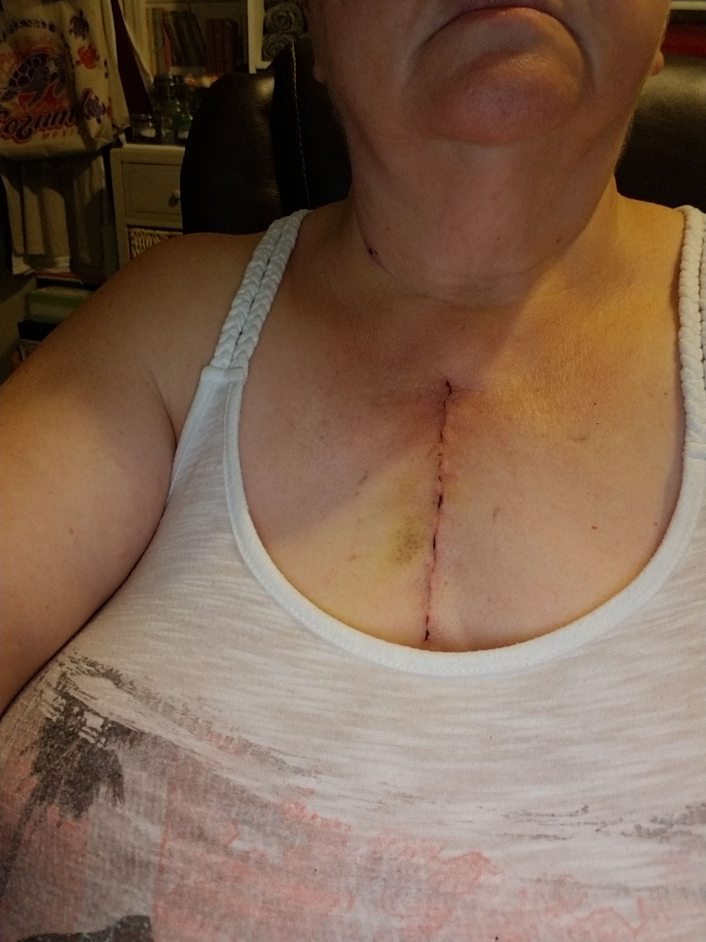 8 days post op