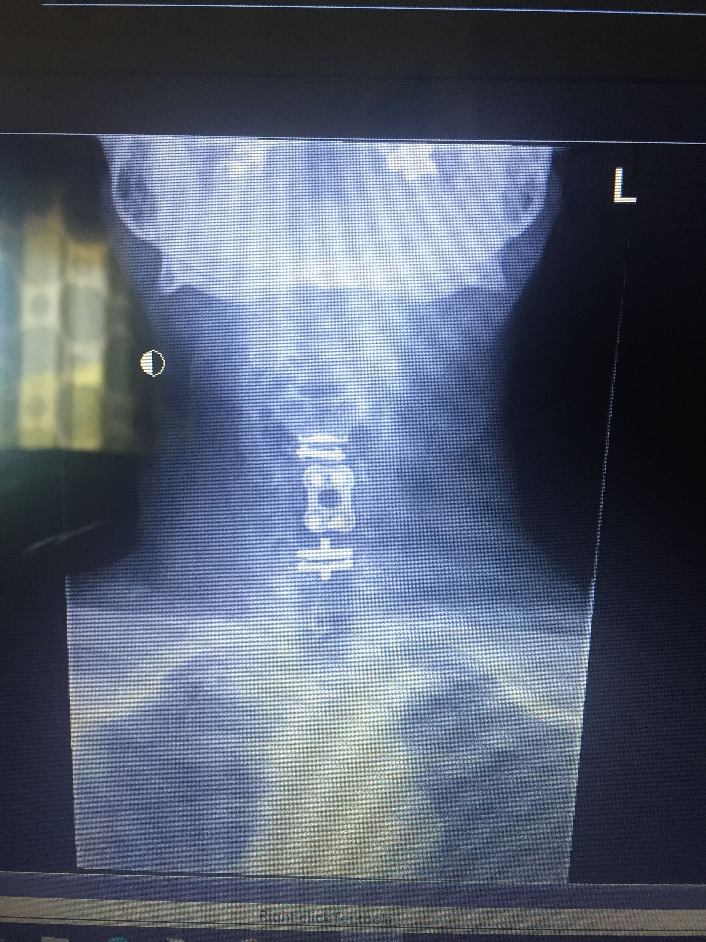 Recovering from myelopathy, 3rd spine surgery from old injuries.
Now to focus on heart aneurysm & valve.