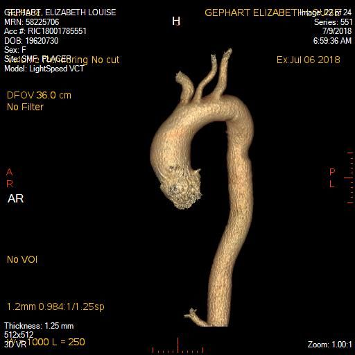 Oops, didnâ€™t realize this posted..but this is a shot of my: Dilated ascending thoracic aorta, measuring 43 x 44 mm...aka 4.4cm ascending aortic aneurysm. See thoracic surgeon in a few weeks.
Take care all, best wishes to everyone!