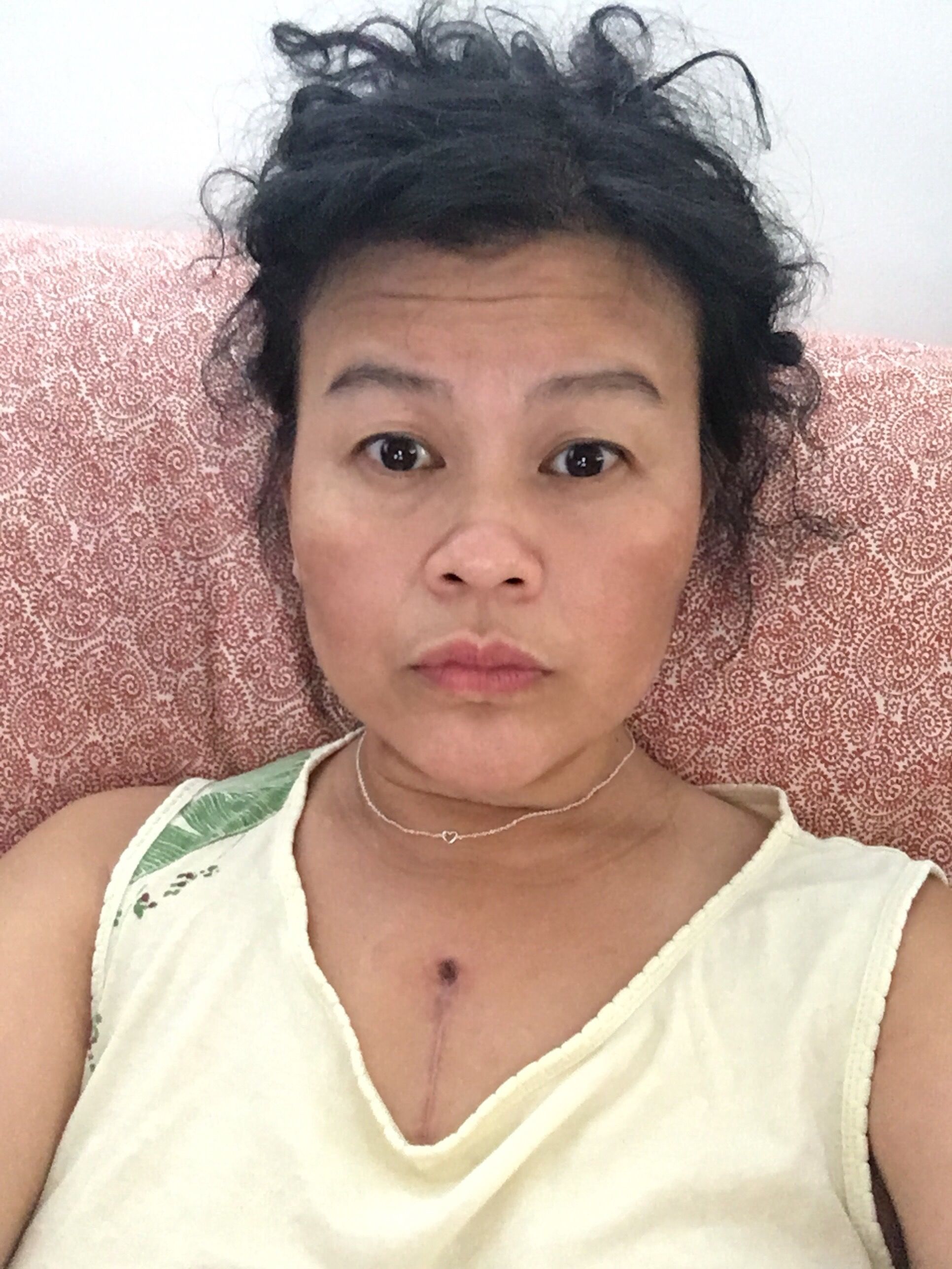 2.5mo after OHS.