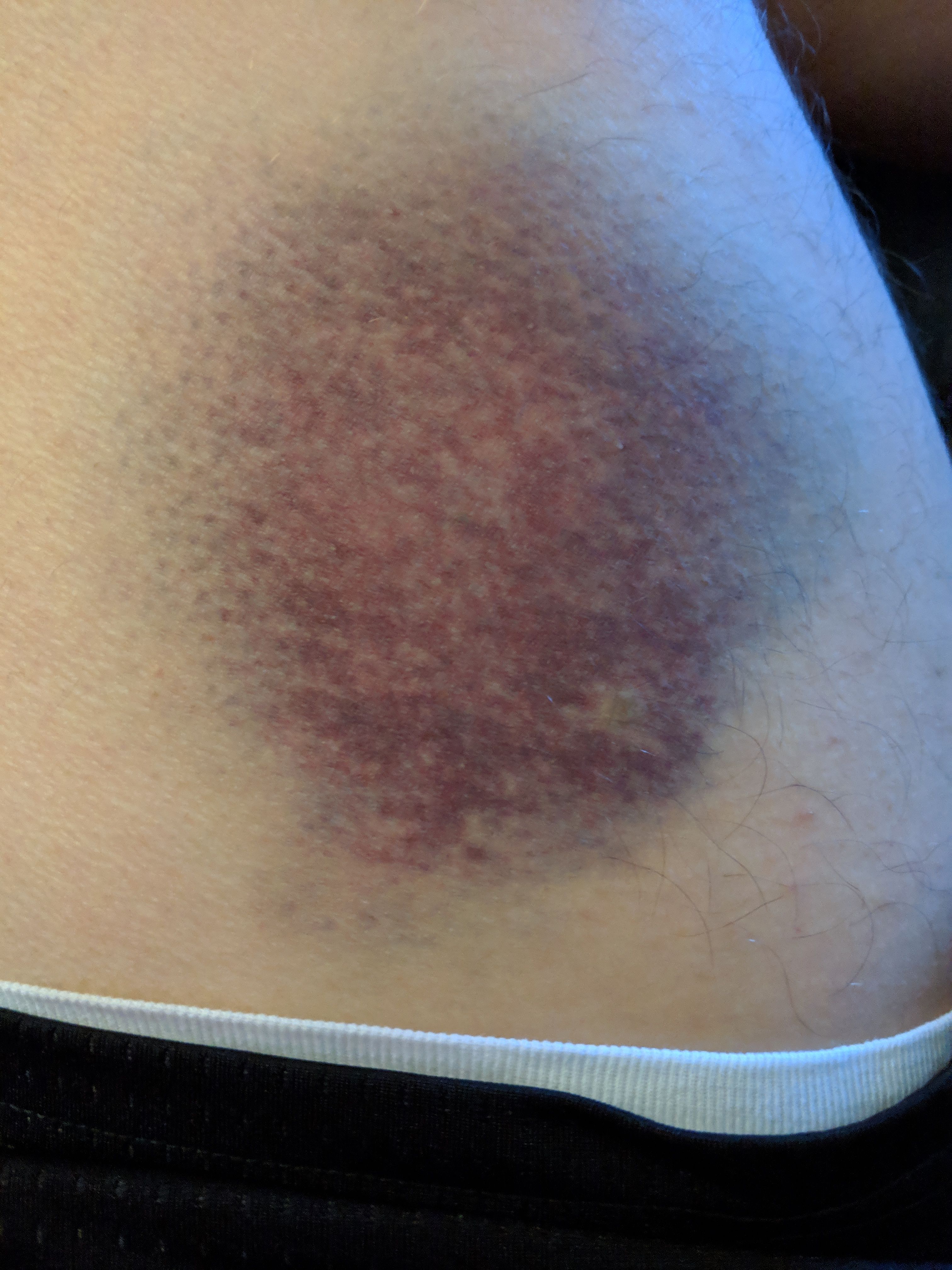 First bad bruise since surgery. That's my inner left thigh... Ouch... Diameter around 5 inches.