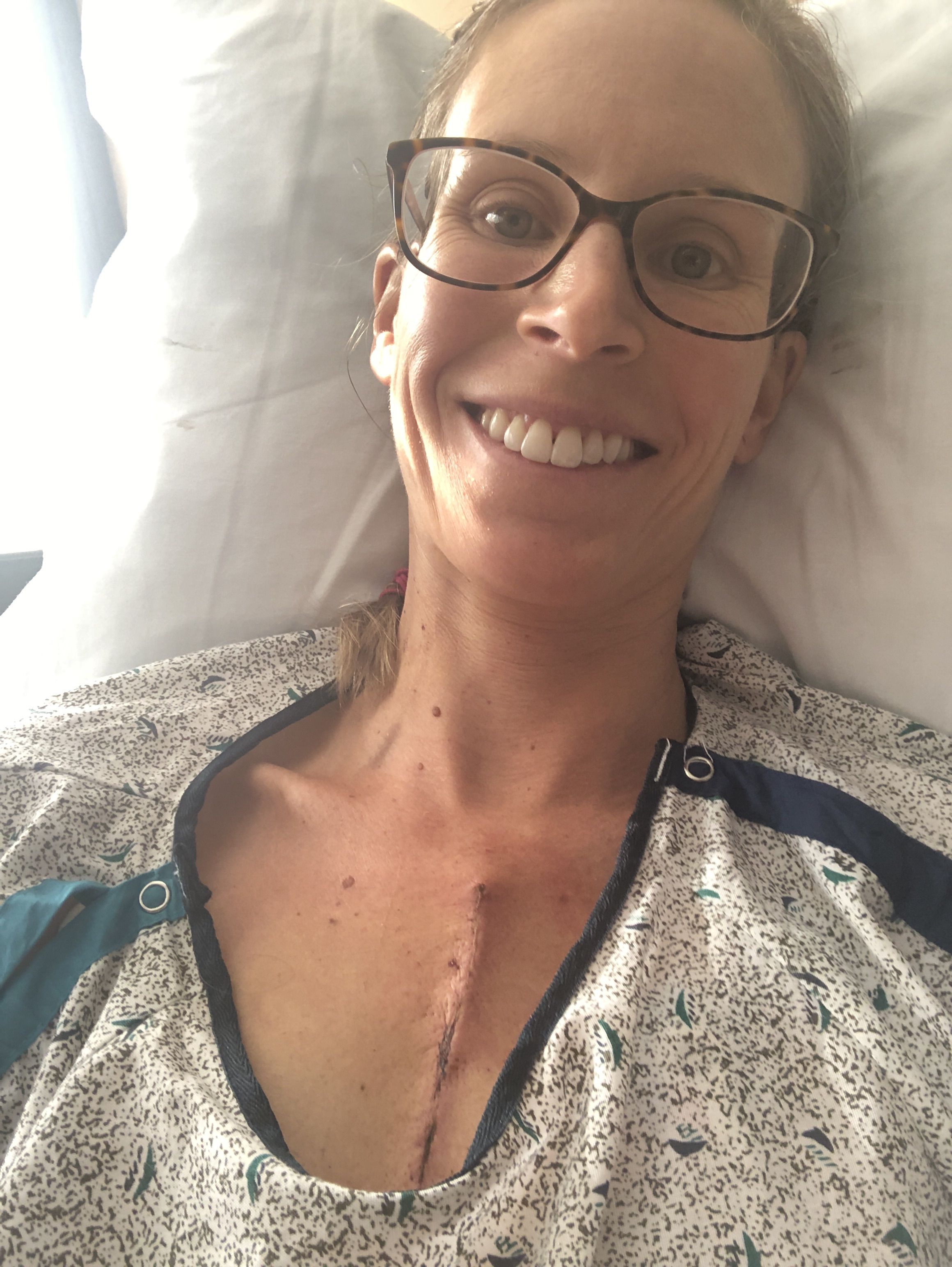 Proud of this scar! Feeling better each day. The first 2 were pretty brutal. Pain meds all worked out, walking everyday and will possibly go home tomorrow!