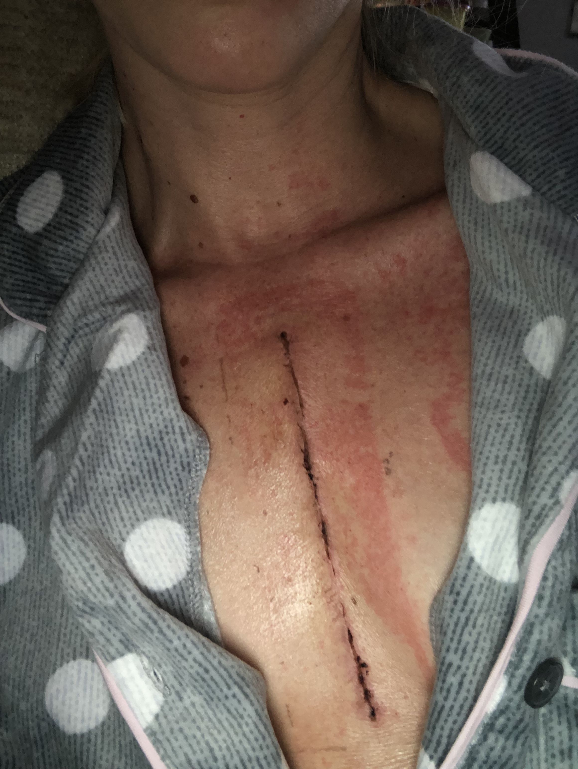 Super itchy rash where my adhesive was. Anyone else experience this a week after surgery?