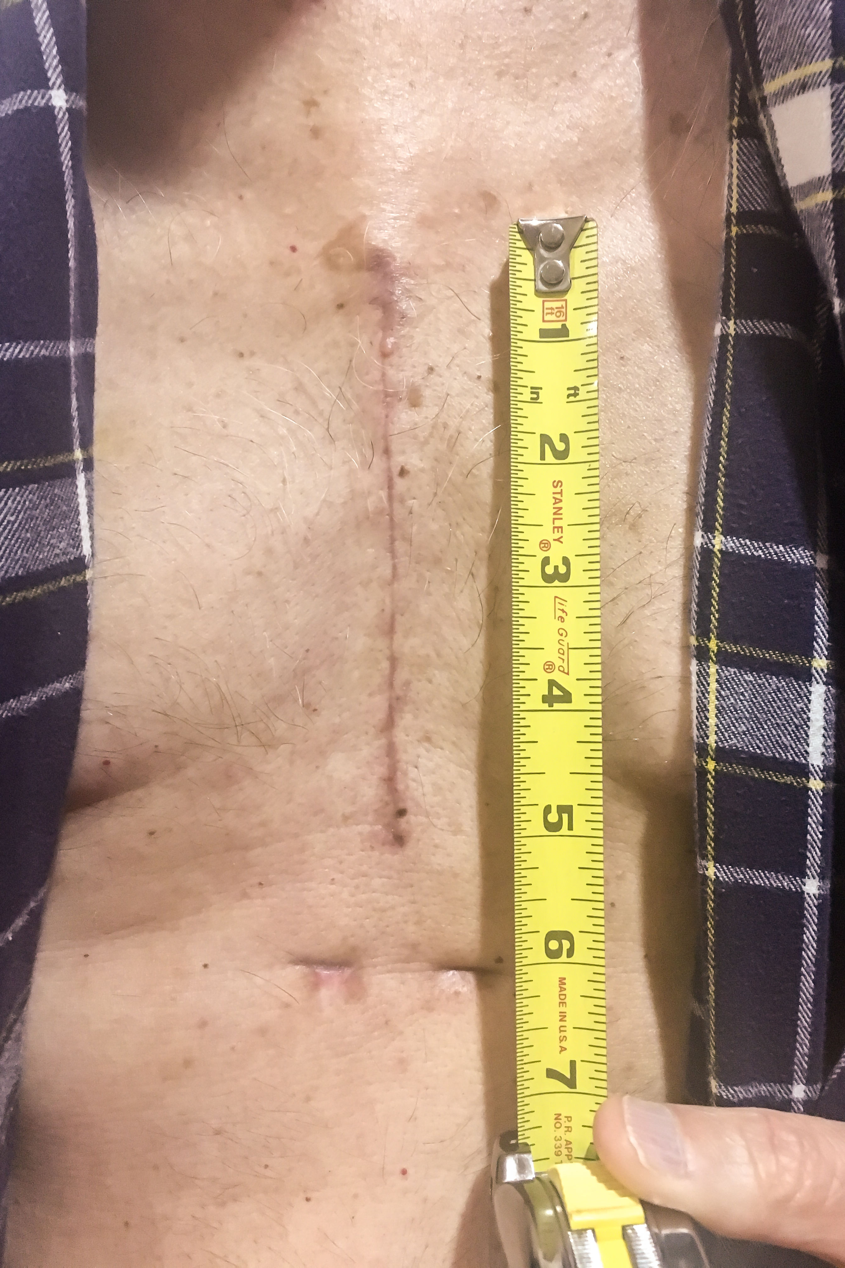 Five weeks post op - Dr. John Parker Gott at Piedmont Atlanta is a Rock Star. Scar looks great!