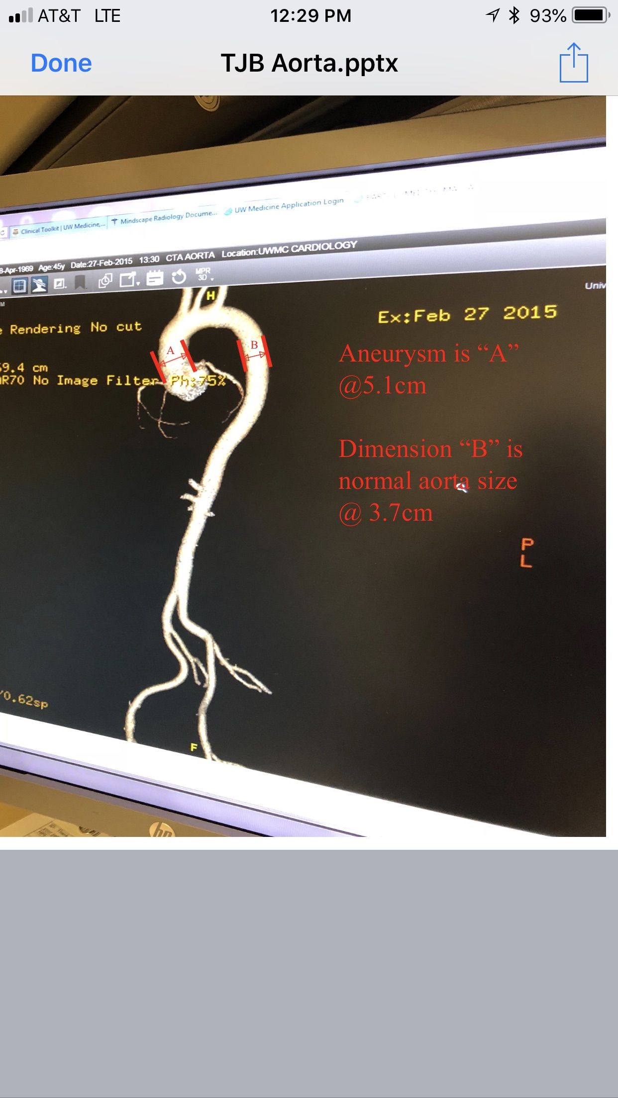 Aortic root aneurysm measuring 5.1cm. It exanded to 5.5cm which was tipping point for me to get it repaired on 11/15/18