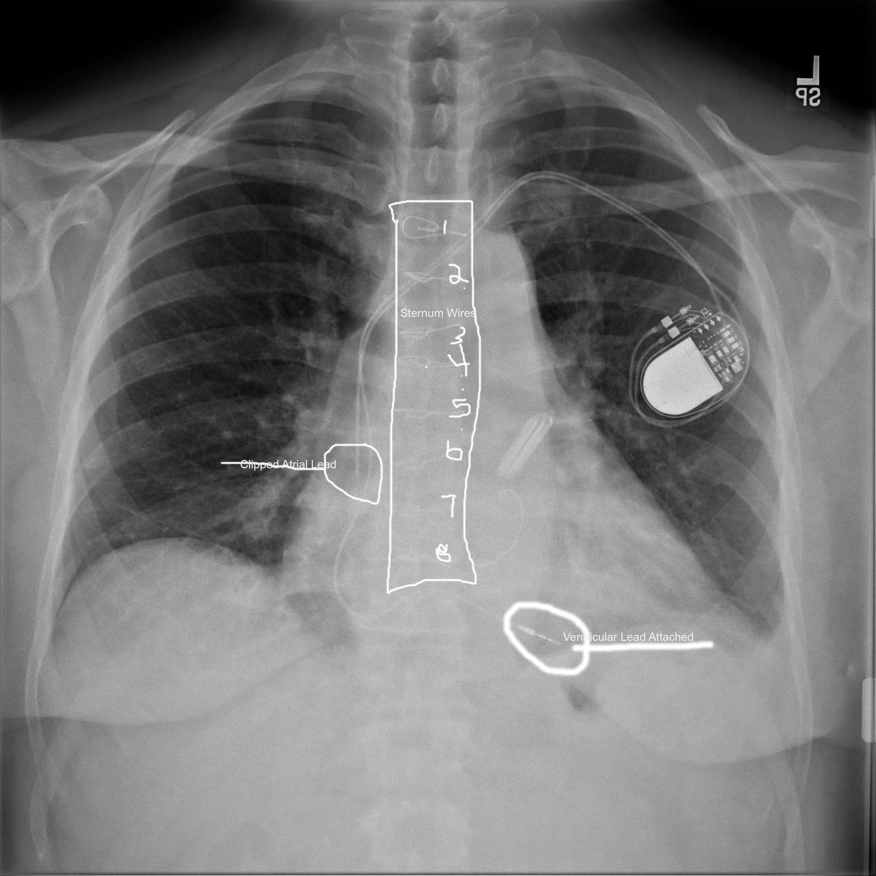 My last chest X-ray a few days ago i tried to tag what i could im not sure if the ring on the right next to the pacemaker is a annuloplasty or the clip for Left Atrial Appendage closure.
