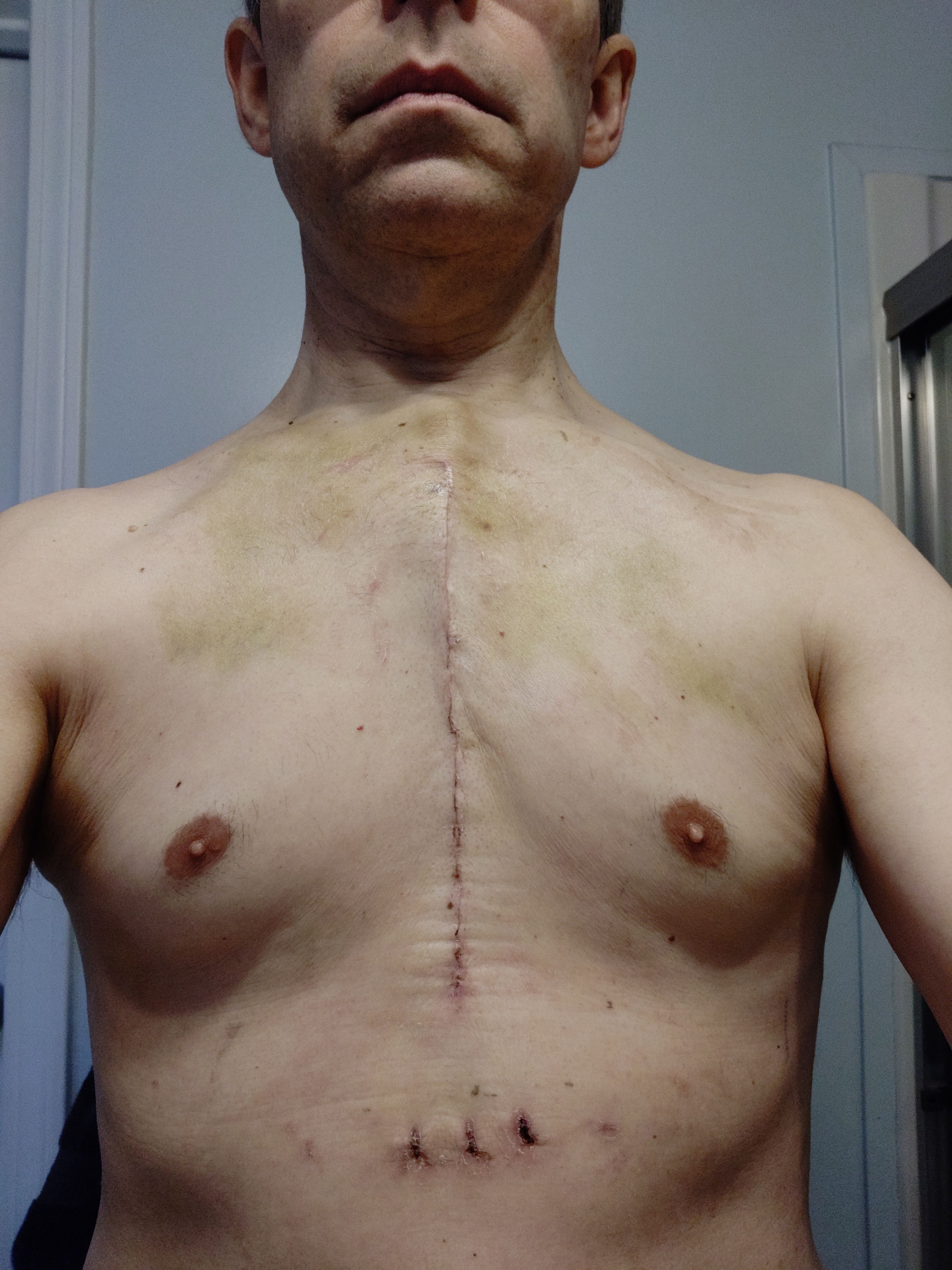 Day 15, finally took off the Steri-strips. Looks like they did a good job.