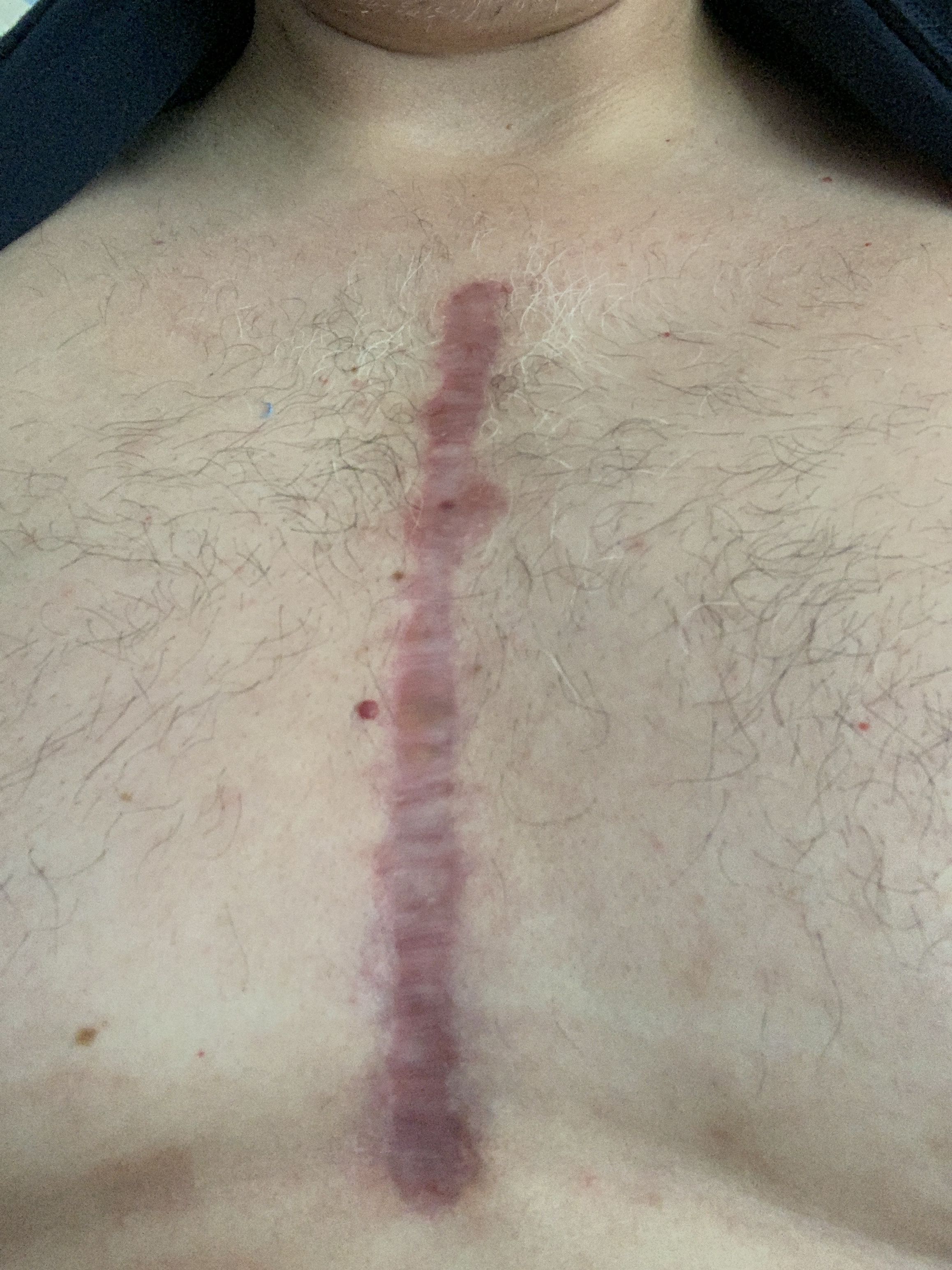 Incision at 7 weeks