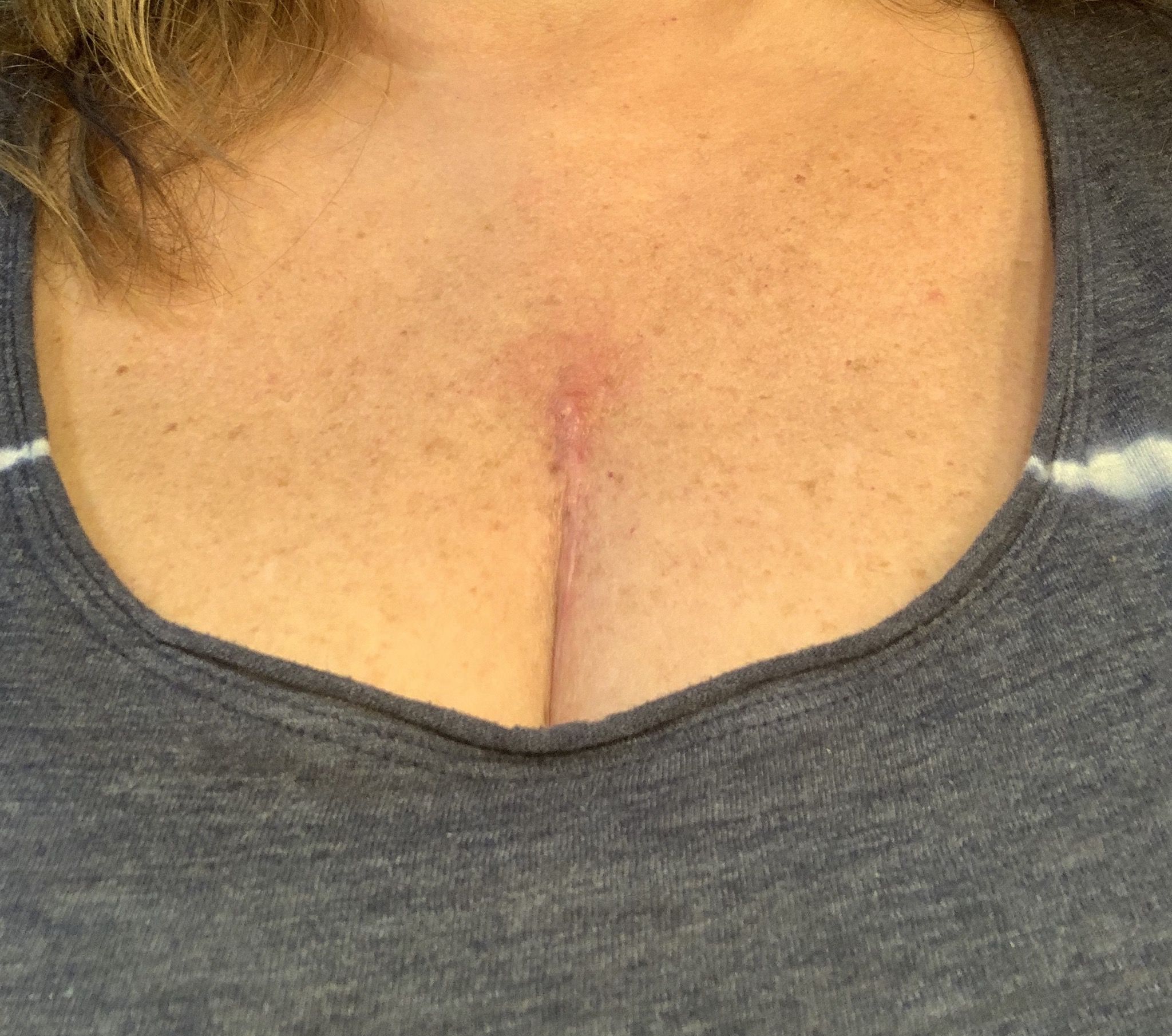 Refer to my previous post. Is the redness at the top of scar normal??