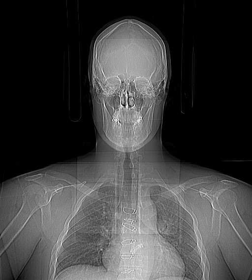 I thought I'd drop this here. The wires and valve can be clearly seen in the CT scan I had today.
