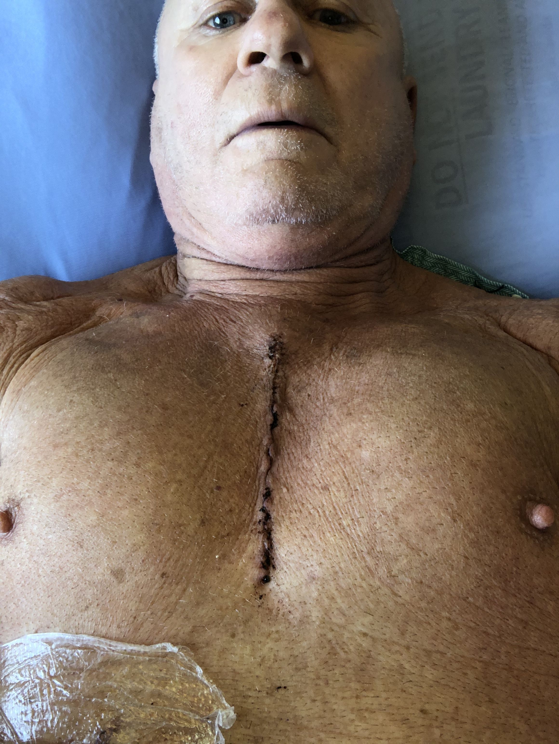 First day after aortic vale replacement February 11 2020 23mm CE Magna Ease bioprosthetic(cow valve)