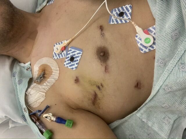 Post op day 5 battle scars. They removed all of the gauze and tape so I could get a clear shot of all the incisions. Thereâ€™s one additional incision in my right groin that I wonâ€™t post due to its sensitive location. Lol.