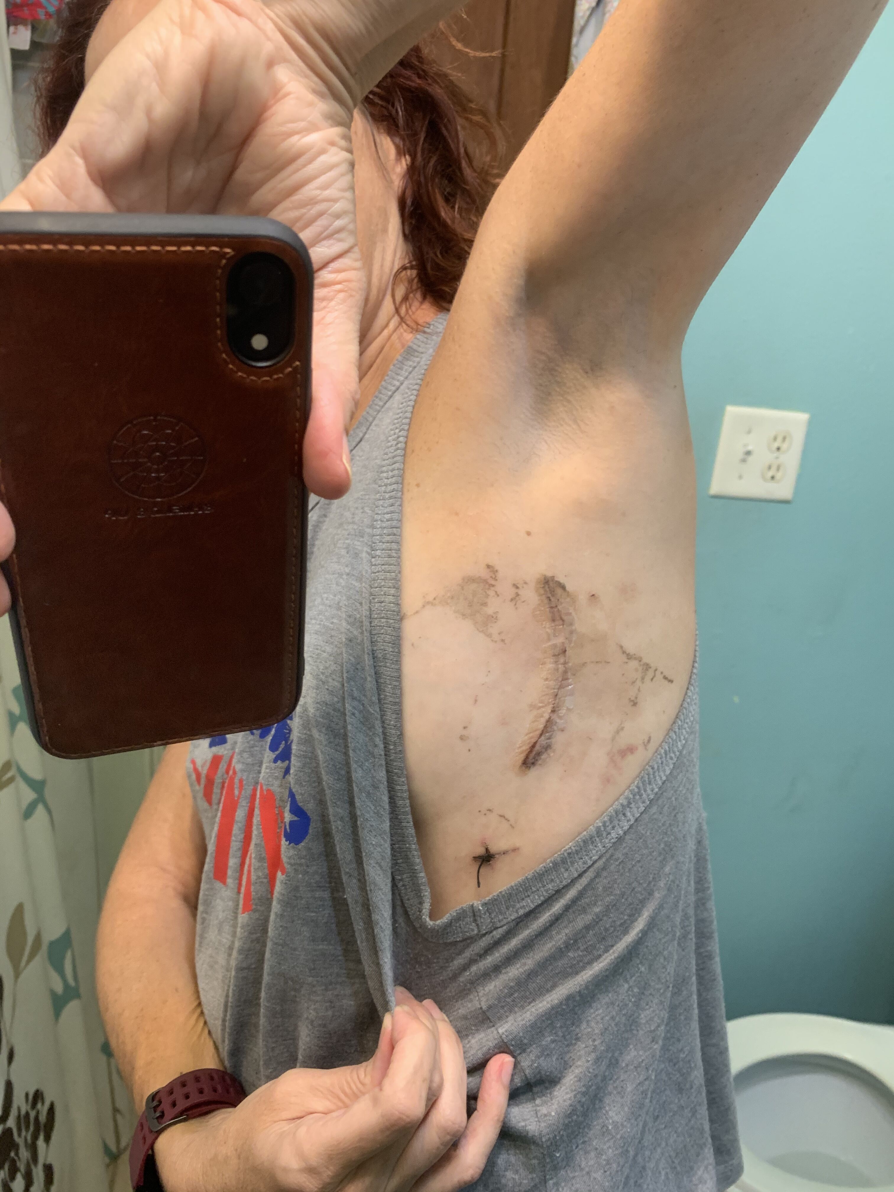 Sharing pic of incision, 17 days after surgery, minimally invasive mitral valve repair. It doesnâ€™t hurt and most of the sensitivity around it has gone away as well. So glad I found a great surgeon nearby that did the side entry approach.