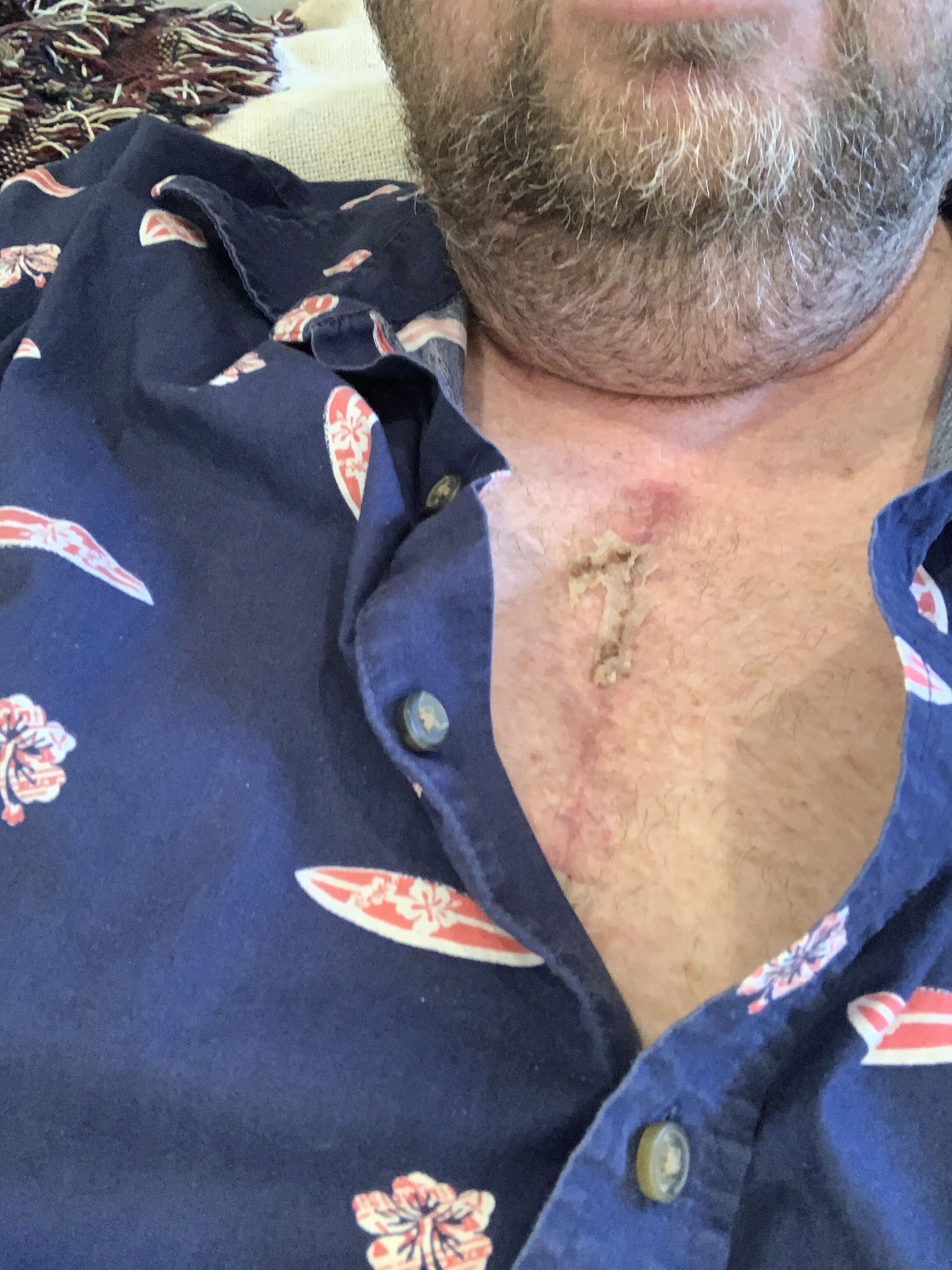 Post Op 3 Weeks

Back home from my recovery retreat up in the mountains. Glad to be home and to be with my fur babies who havenâ€™t left my side. Had a great virtual checkup with my cardiologist and most of the surgical glue has flaked off and the
