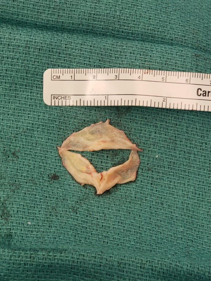 Here is my bicuspid aortic valve...not sure how this held on as long as it did!