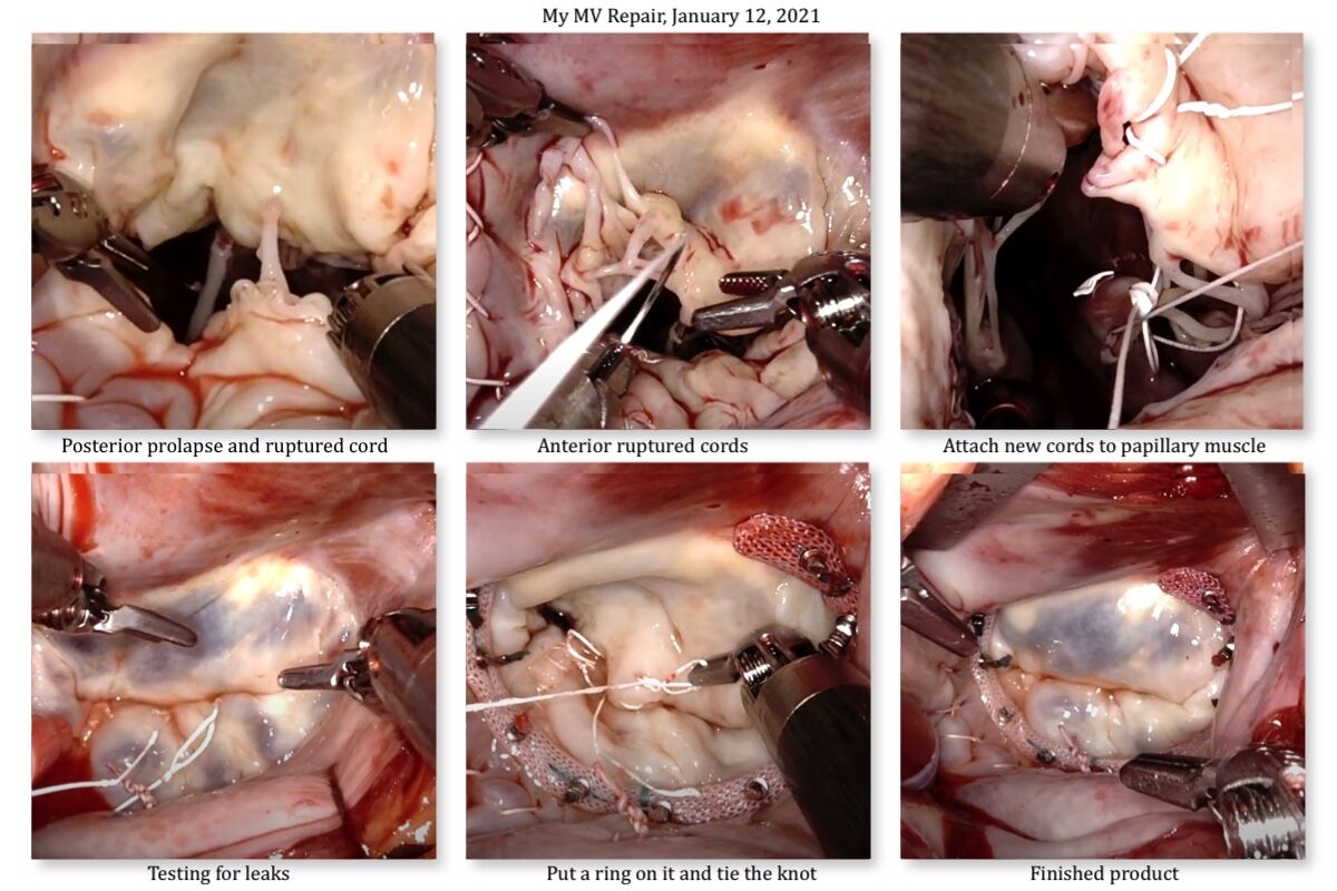 If anyone wants to see the before and after of a great robotic surgery, here's my MV repair of a prolapsed posterior leaflet with a ruptured cord, and two anterior leaflet ruptured cords. Pretty amazing how far we've come with surgical techniques and exec