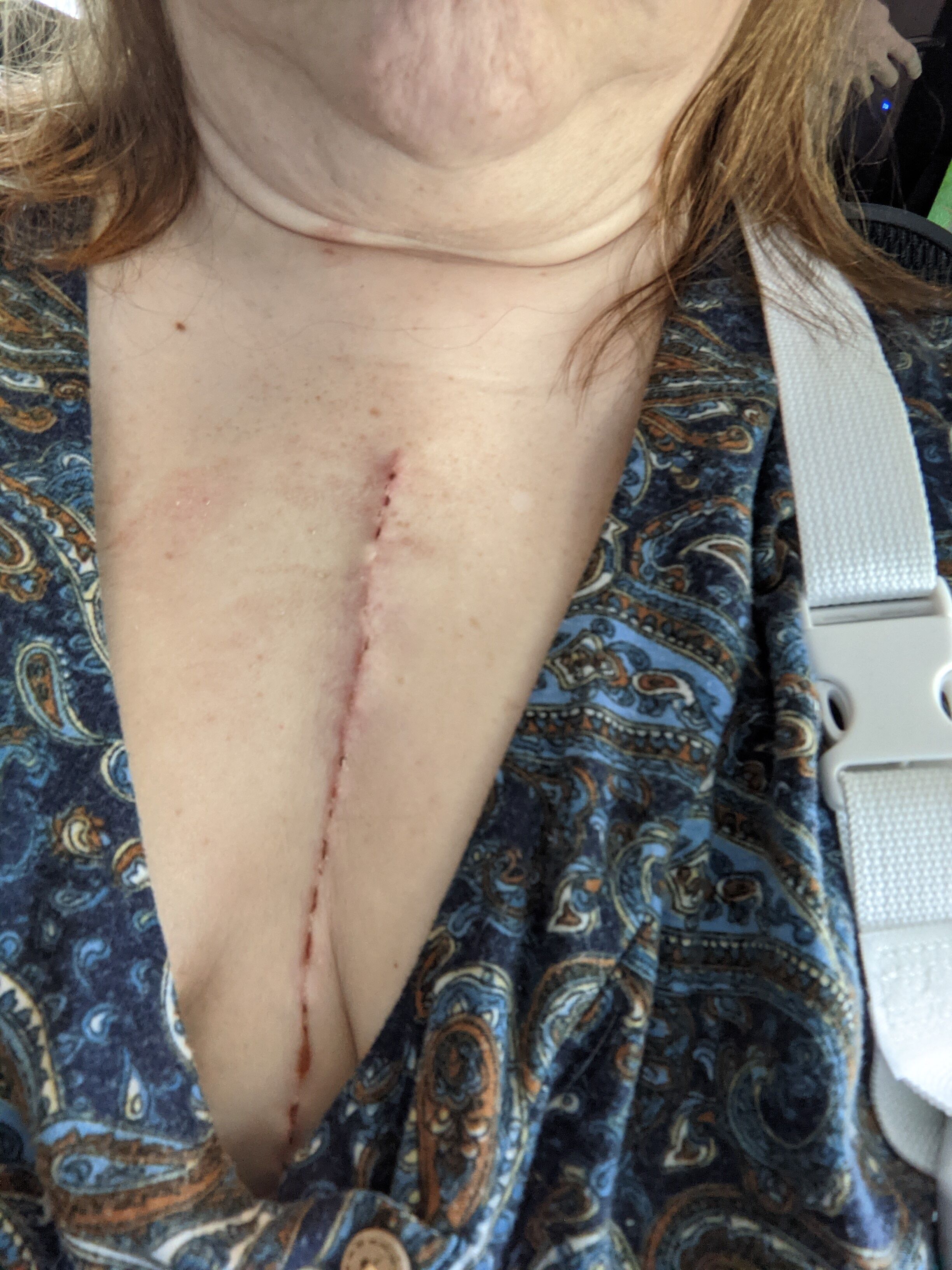 26 days healing well.