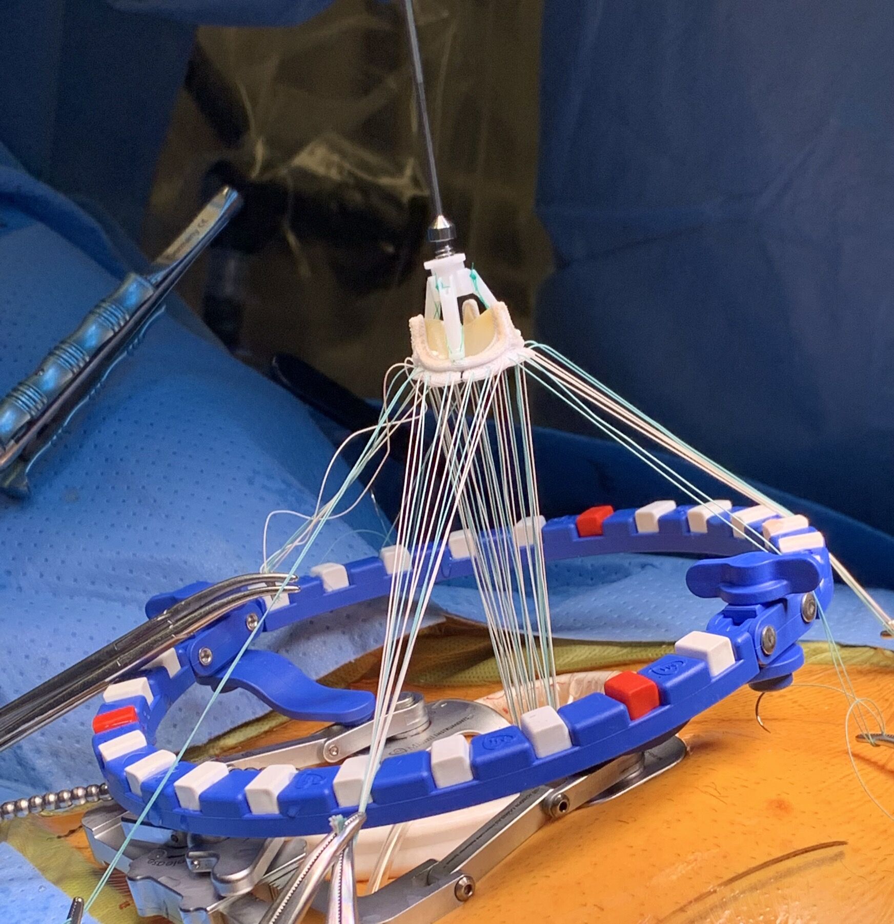 In with a new Richards bioprosthetic valve