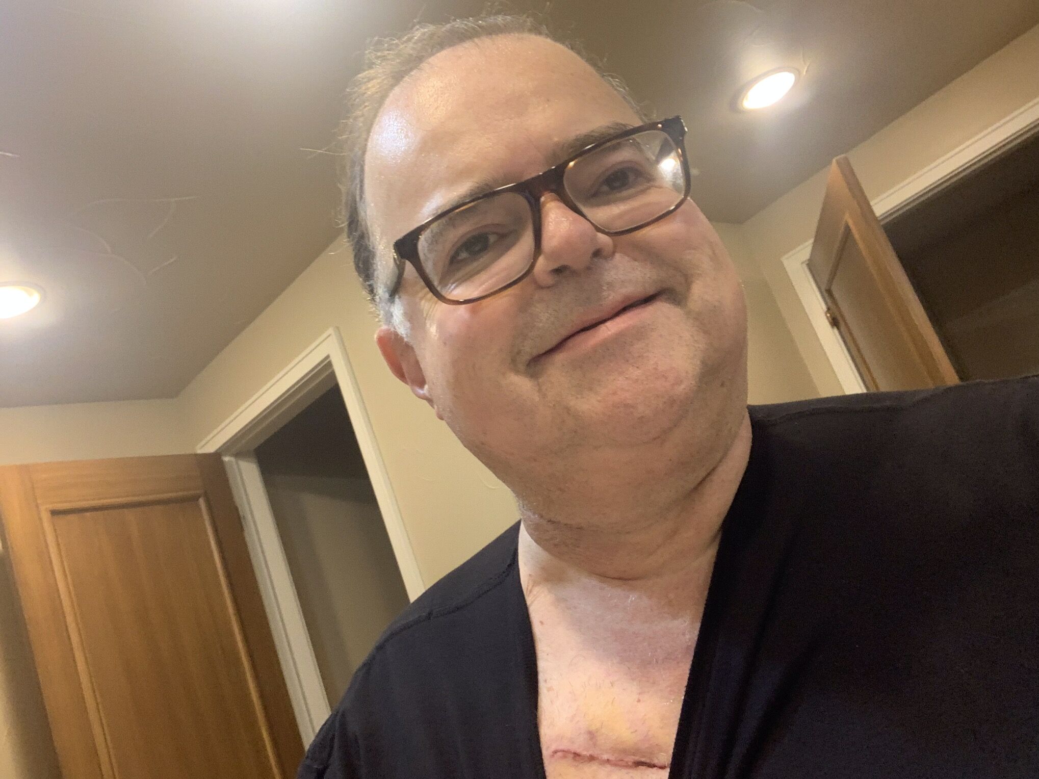 Hi warriors ! 8 days post op mini thorocotomy .AVR Fatigue dissipating daily. Incision has no pain. BP spiked significantly and feel hot. The people at UT Southwestern are changing my BP meds and they seem to be responding.Physiologic changes from sudden